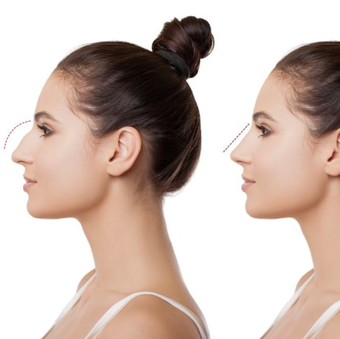 Restylane Lyft Nose Reshaping image 1